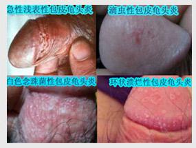 龟头炎